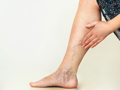 a person's leg with a varicose veins